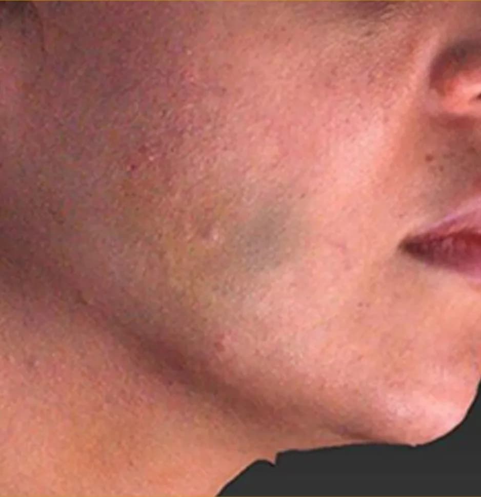 Case 06, after treatment